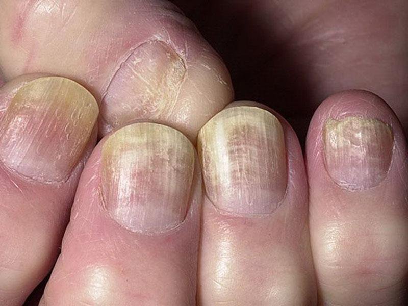 грибок ногтей аппаратное лечение (1)