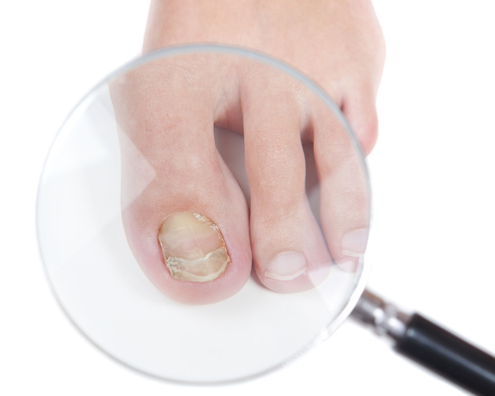 Doctor dermatologist examines the nail on the presence of the fu
