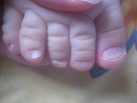 грибок ногтей у детей