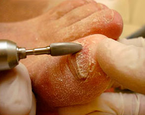лечение ногтей аппаратная чистка