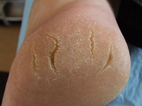 Почему трескается кожа на пятках и как избавиться от трещин в «СМ-Косметология»